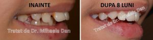 179 aparat dentar bracketuri metalice safir ceramica doctor bun indreptare dinti Mihaela Dan mireasa