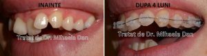 184 aparat dentar bracketuri metalice safir ceramica doctor bun indreptare dinti Mihaela Dan mireasa