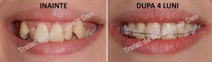 190 aparat dentar bracketuri metalice safir ceramica doctor bun indreptare dinti Mihaela Dan mireasa