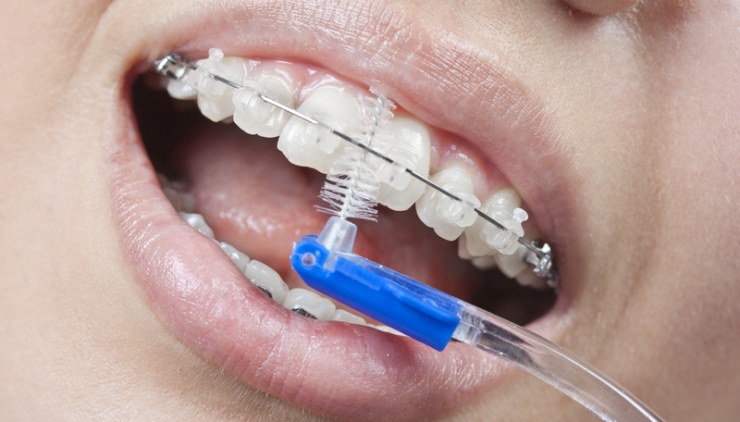 Informatii utile inainte de a-ti pune aparat dentar