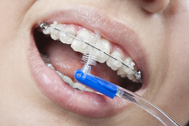 Informatii utile inainte de a-ti pune aparat dentar