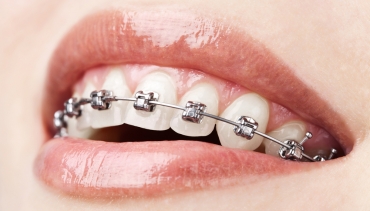 Aparat dentar fix adulti – Informații utile