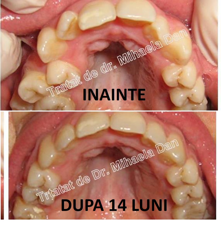 Egypt Diplomacy versus Aparat dentar - Cazuri - Orto Implant Expert este specializata in tratamen  ...