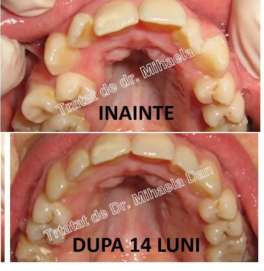 Red date Not essential texture Aparat dentar - Cazuri - Orto Implant Expert este specializata in tratamen  ...