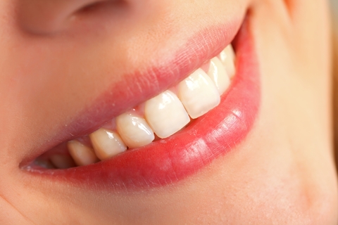 Ce sa aleg – fatete dentare sau aparat dentar