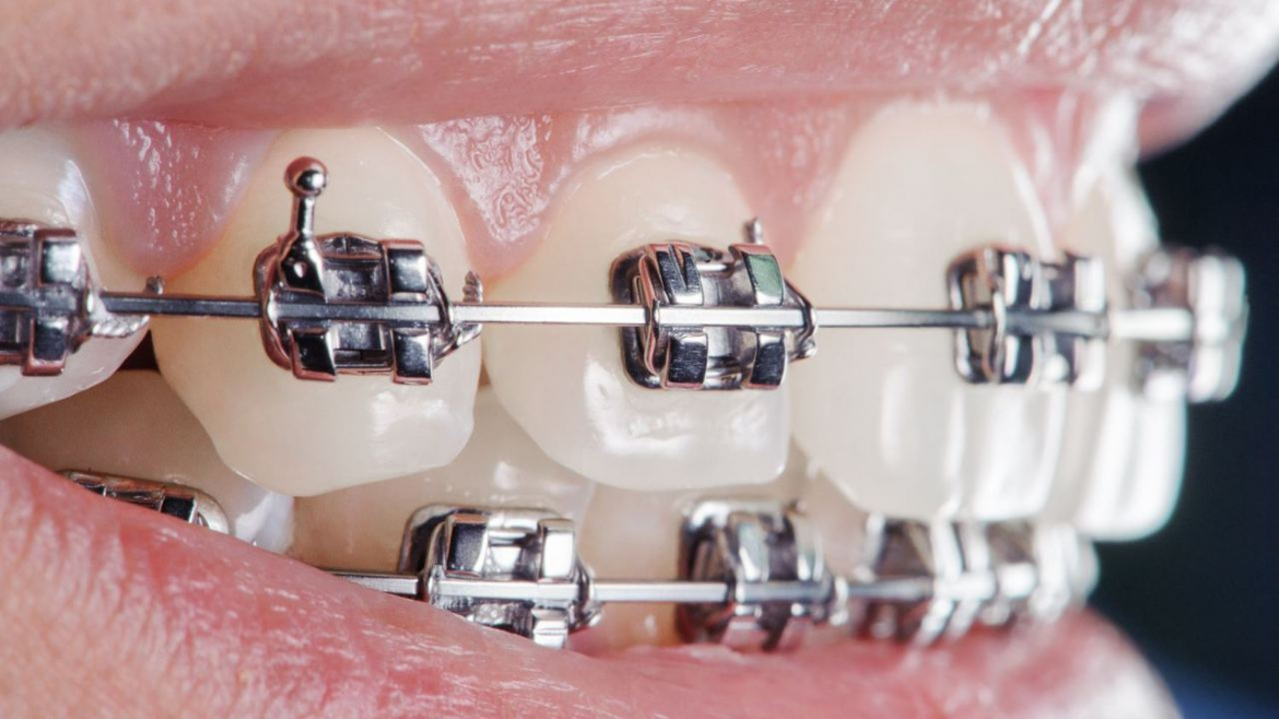 Cum sa previi cariile cand ai aparat dentar