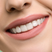 Am dinții strâmbi – ce să aleg – aparat dentar sau fațete