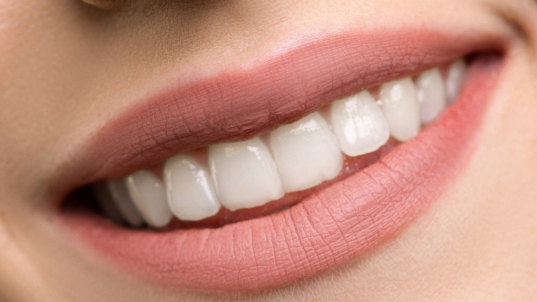 Am dinții strâmbi – ce să aleg – aparat dentar sau fațete